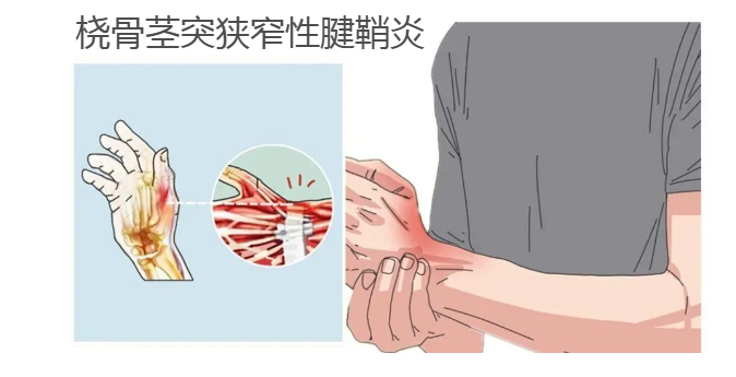 爱玩手机的人注意了！手腕咔咔响不是骨折，而是......